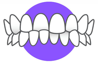 «Съехавший» ряд зубов