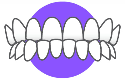 Выпирающий ряд зубов